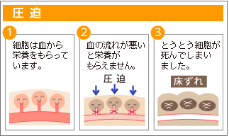 床ずれを作らない 進行させない 介護用品の通販 販売店 品揃え日本最大級 快適空間スクリオ