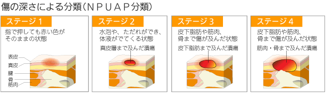 傷の深さによる分類