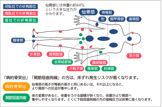 床ずれになりやすい場所の確認